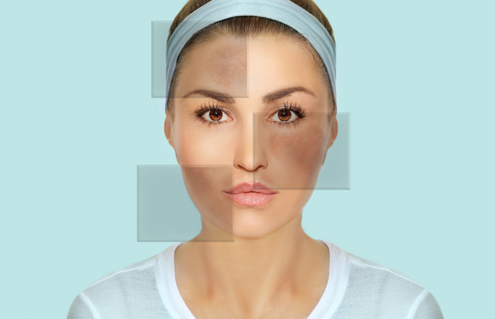 What is Melasma and How to Manage and Prevent It?